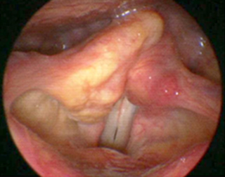 喉頭アミロイドーシス（右披裂部）